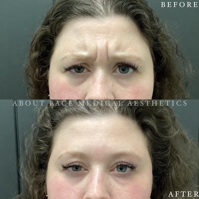 Botox Before & After Gallery - Patient 130273 - Image 1