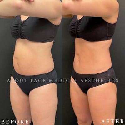 CoolSculpting Before & After Gallery - Patient 243152 - Image 1
