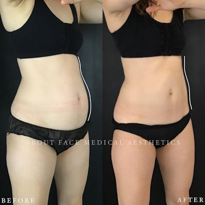 CoolSculpting Before & After Gallery - Patient 212177 - Image 1