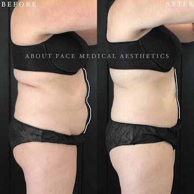 CoolSculpting Before & After Gallery - Patient 231498 - Image 1