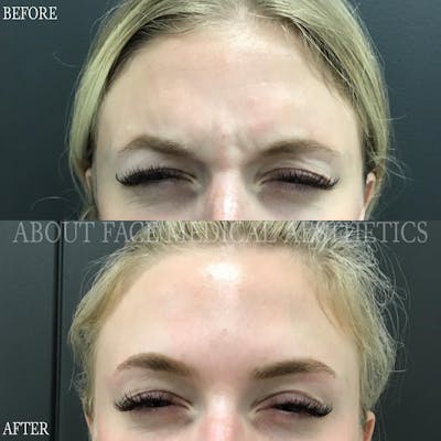 Botox Before & After Gallery - Patient 414039 - Image 1