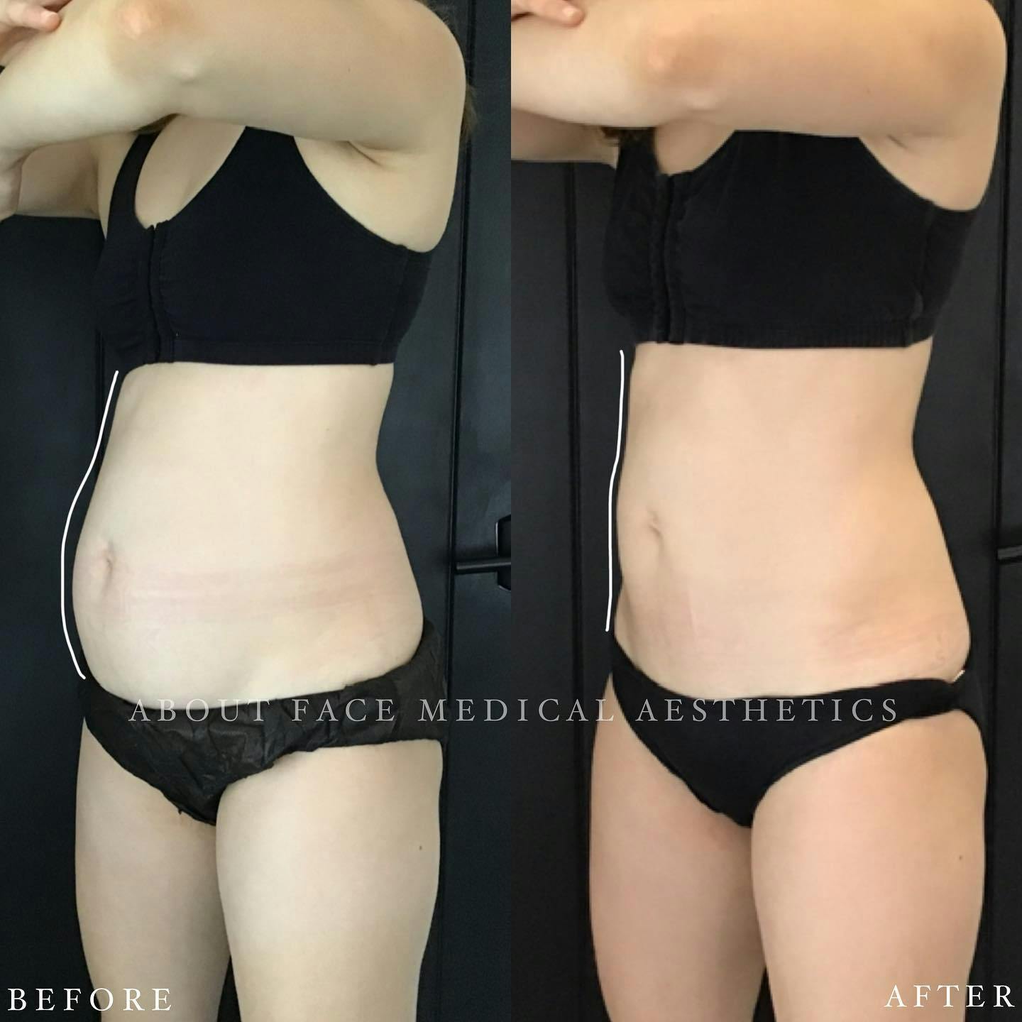 CoolSculpting Before & After Gallery - Patient 212177 - Image 2