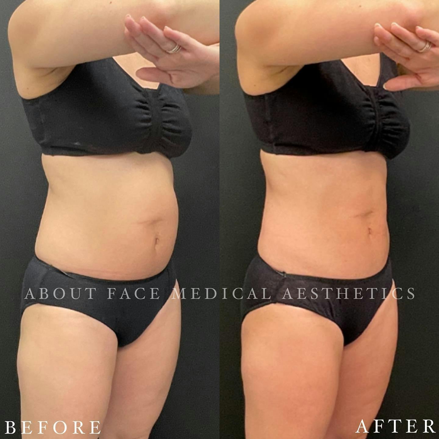 CoolSculpting Before & After Gallery - Patient 243152 - Image 2