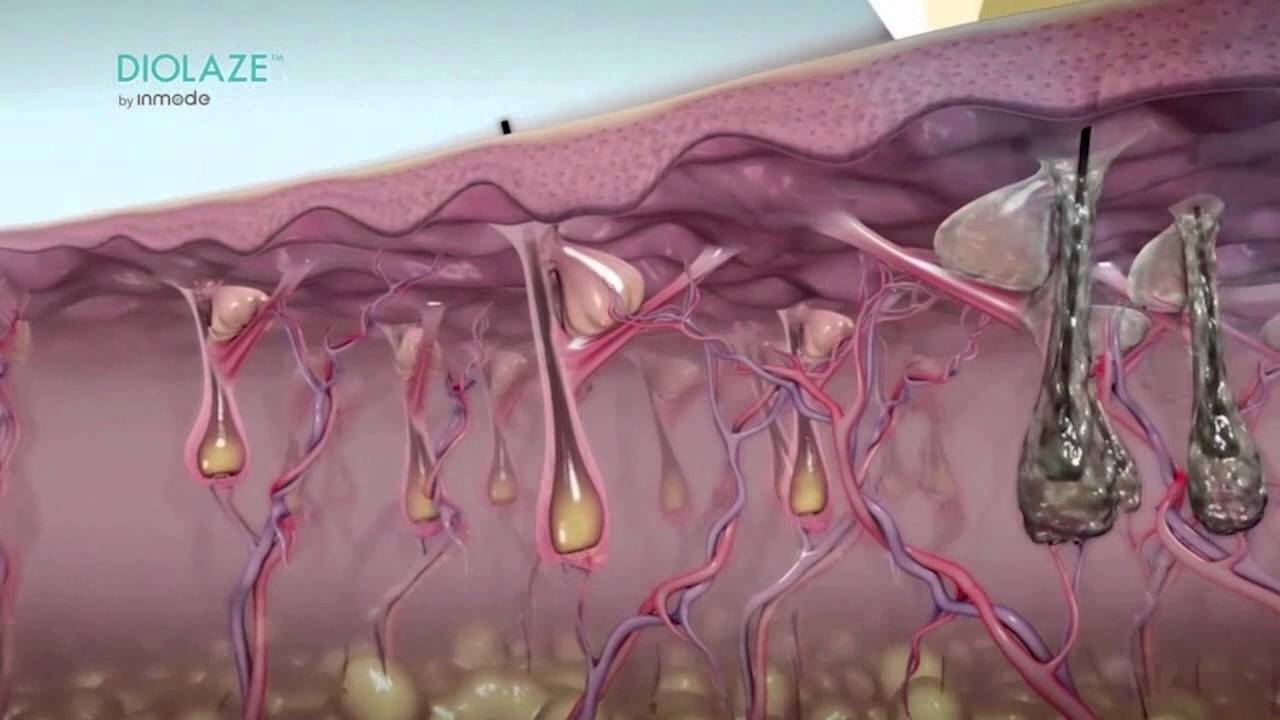 animated diagram of the laser hair removal process