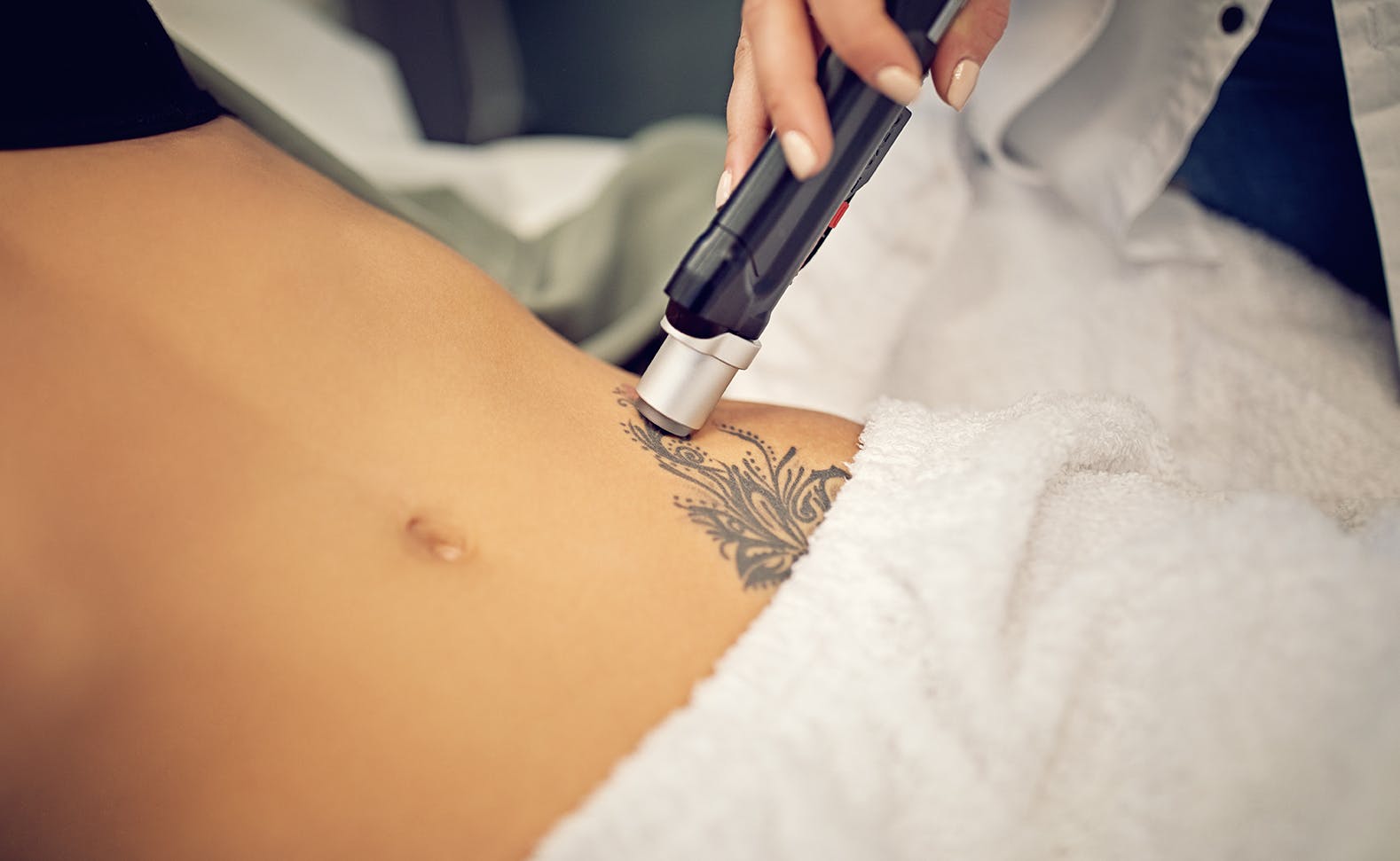 Tattoo Removal | Grossman Dermatology