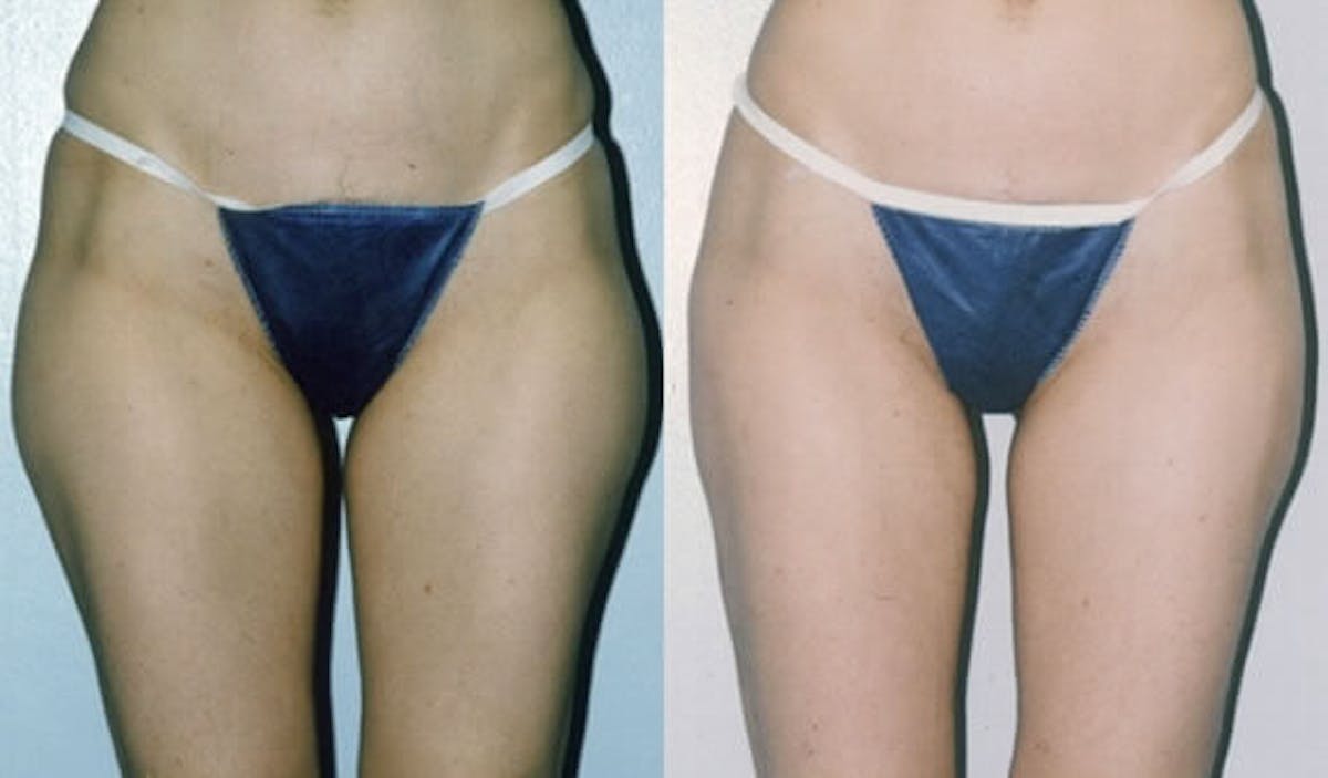 Liposuction Before & After Gallery - Patient 42063892 - Image 1