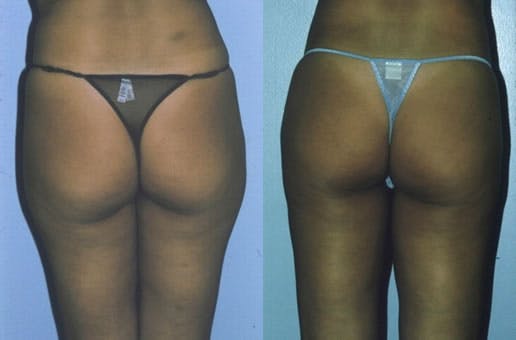 Liposuction Before & After Gallery - Patient 42063893 - Image 1