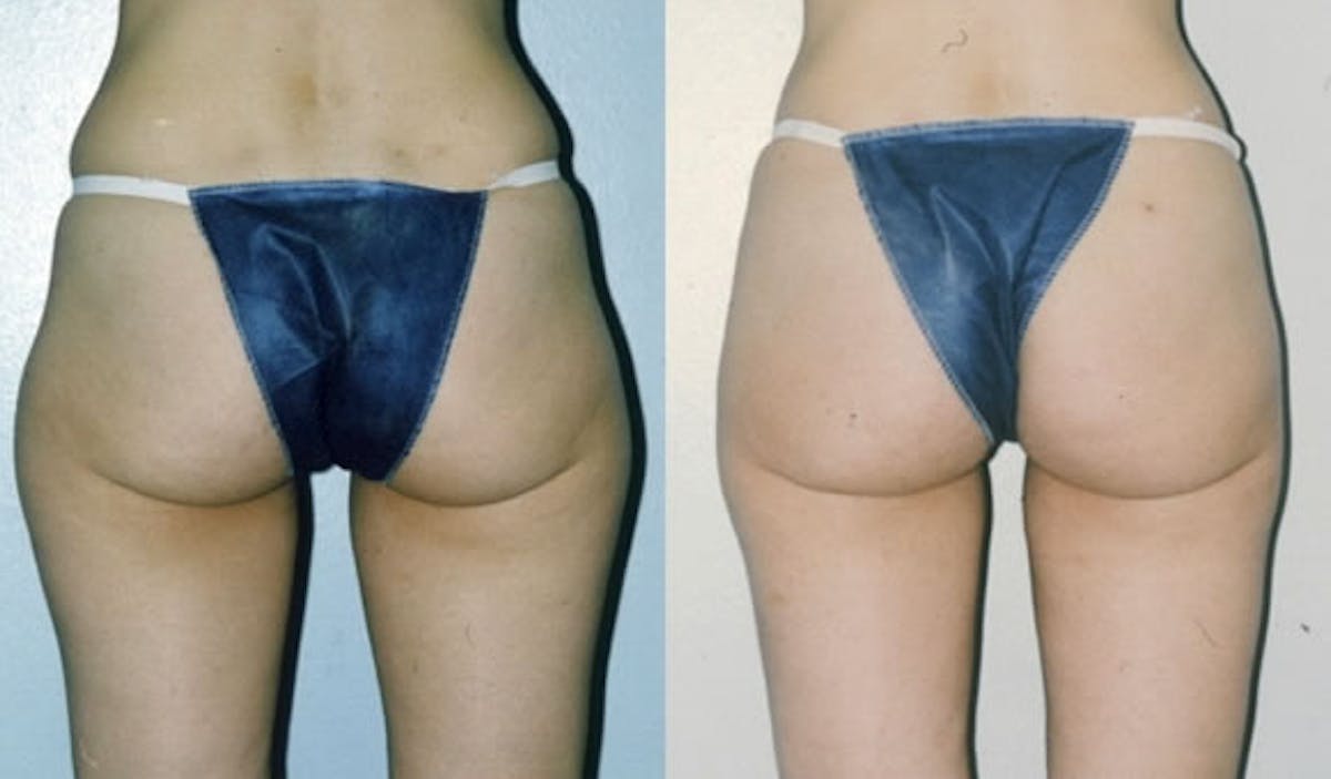 Liposuction Before & After Gallery - Patient 42063892 - Image 2