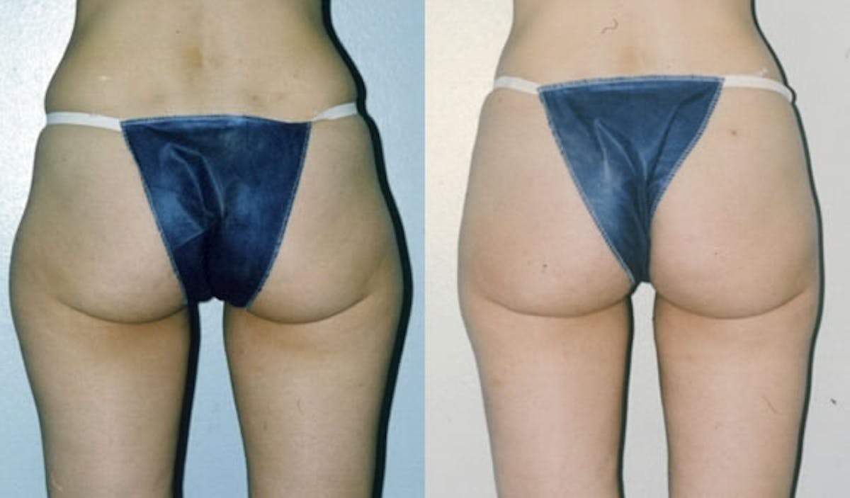 Liposuction / Bodytite Before & After Gallery - Patient 42063892 - Image 2