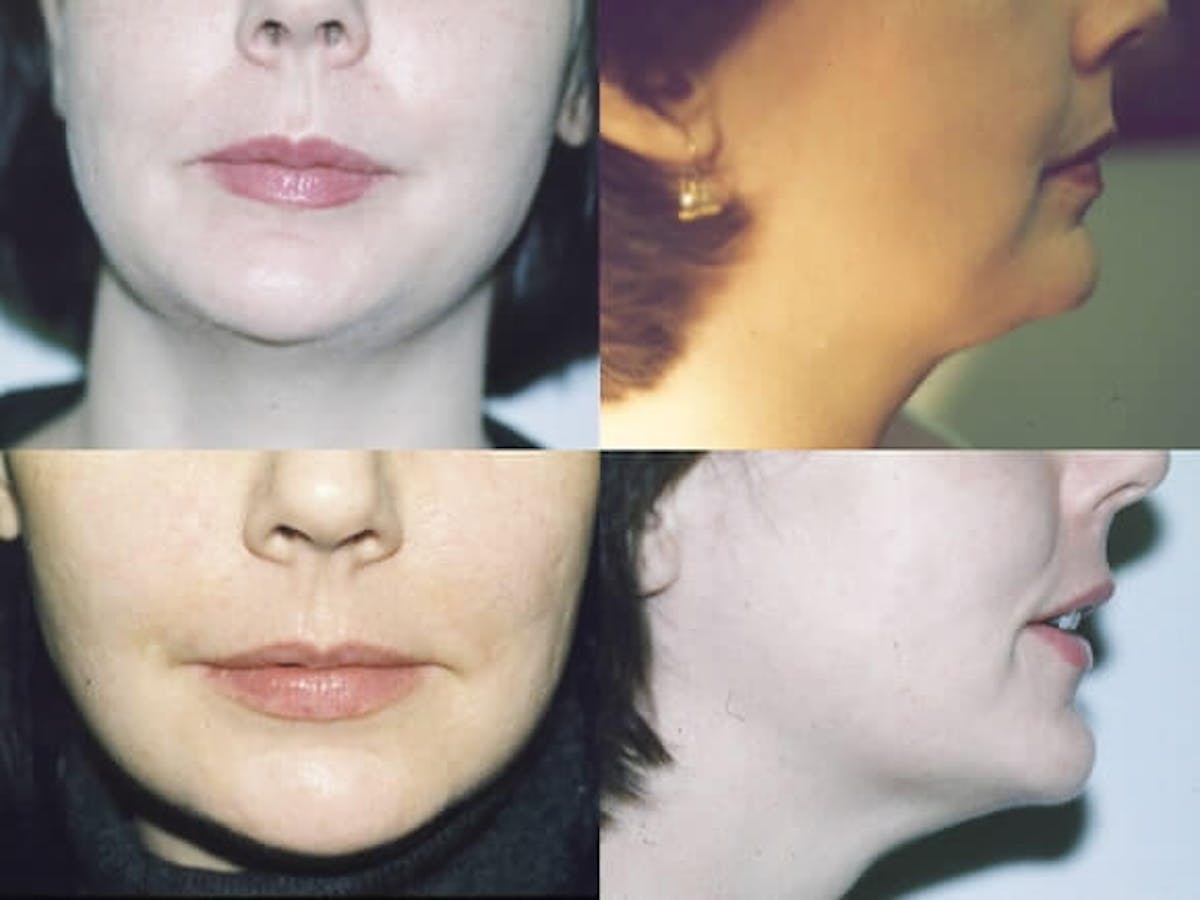 Liposuction / Bodytite Before & After Gallery - Patient 42063894 - Image 1