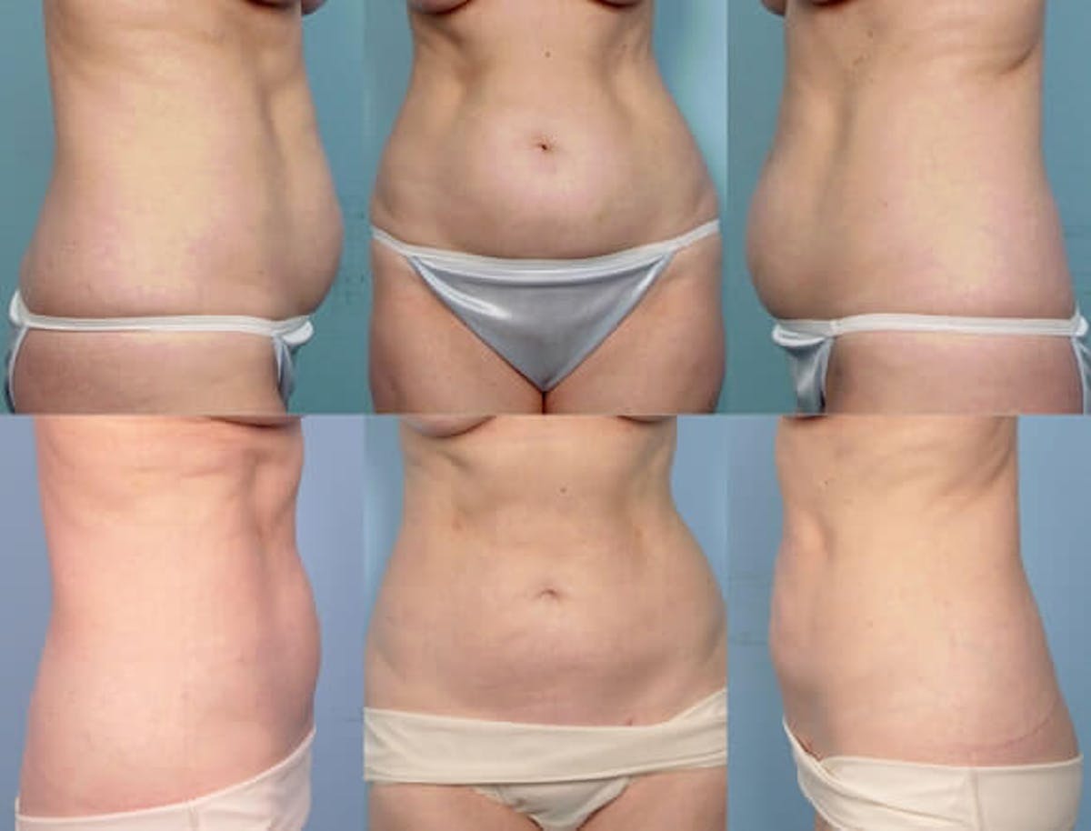 Liposuction Before & After Gallery - Patient 42063895 - Image 1