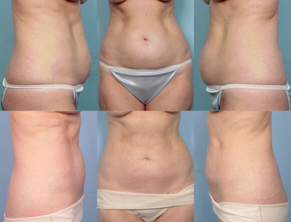 Liposuction Before & After Gallery - Patient 42063895 - Image 1