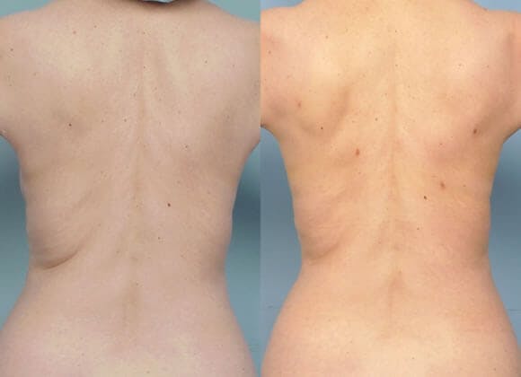 Liposuction Before & After Gallery - Patient 42063896 - Image 1