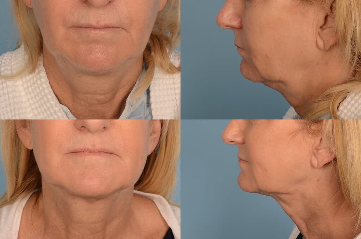 Liposuction / Bodytite Before & After Gallery - Patient 42063897 - Image 1