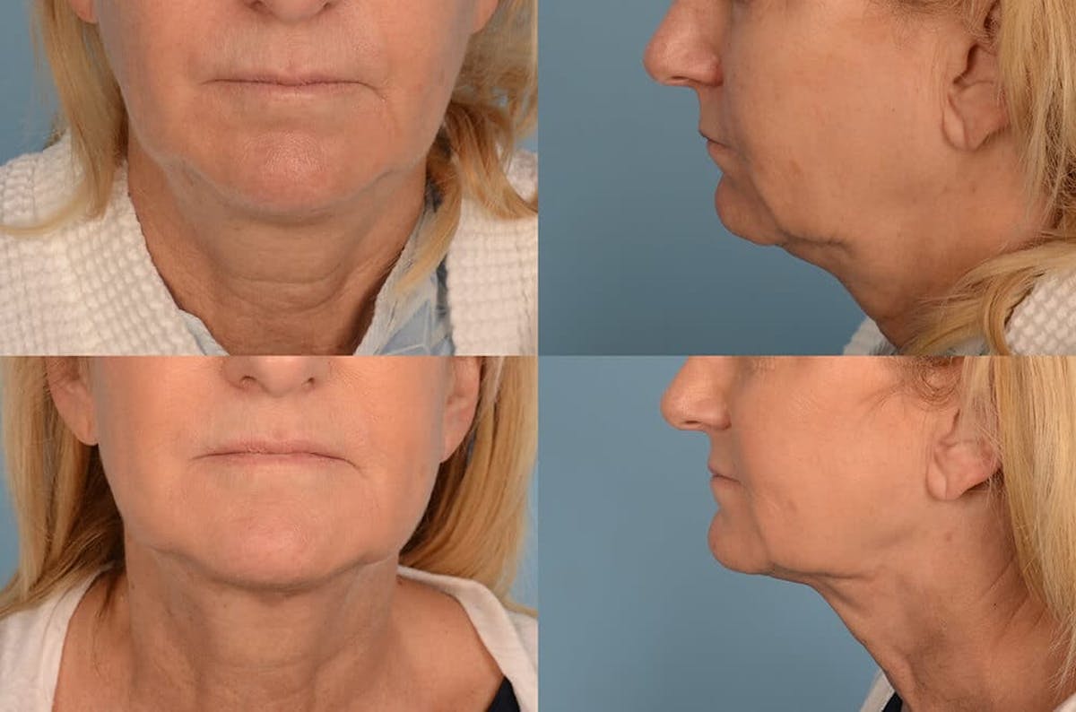 Liposuction Before & After Gallery - Patient 42063897 - Image 1