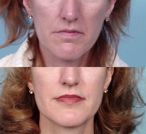 Lipotransfer