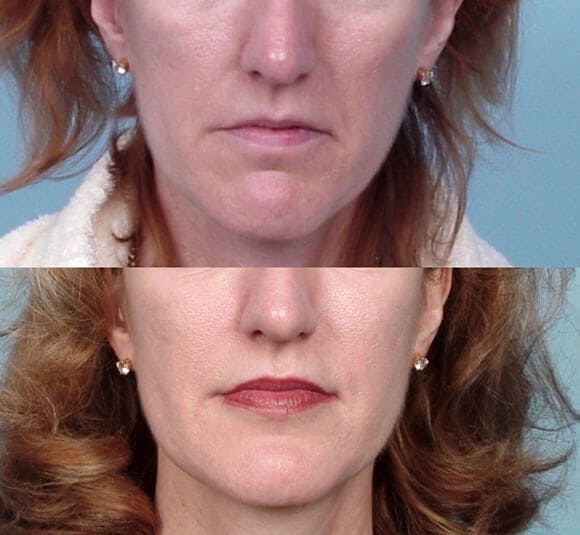 Lipotransfer Before & After Gallery - Patient 42063898 - Image 1