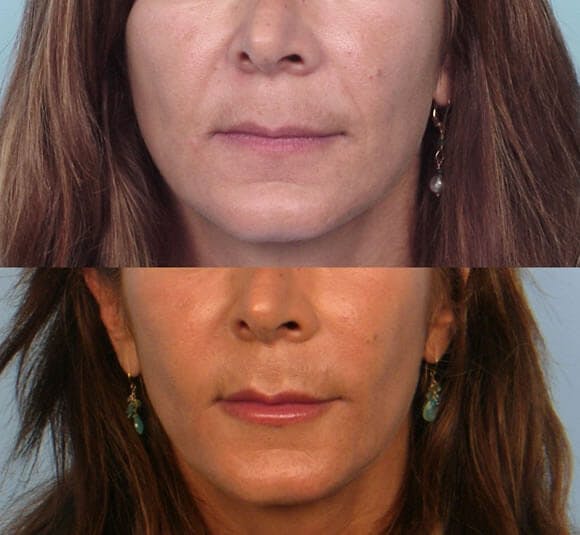 Lipotransfer Before & After Gallery - Patient 42063899 - Image 1