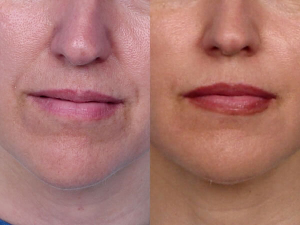Lipotransfer Before & After Gallery - Patient 42063900 - Image 1