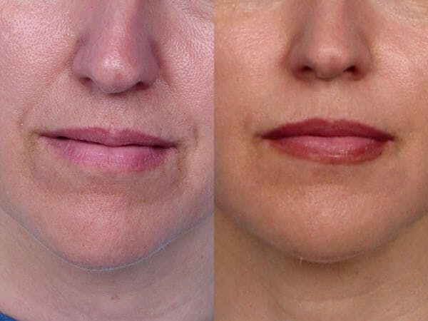 Lipotransfer Before & After Gallery - Patient 42063900 - Image 1