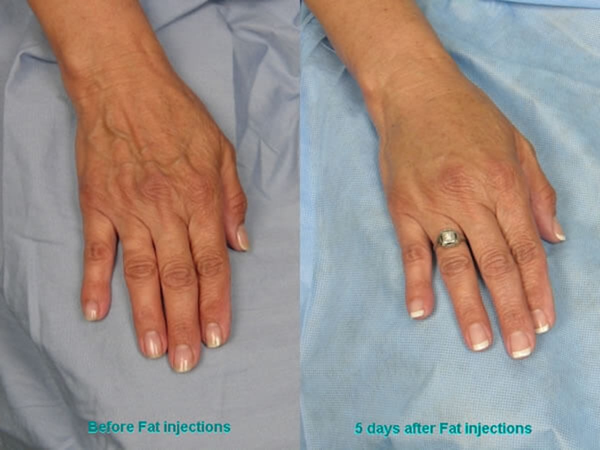 Crepey Skin Before & After Gallery - Patient 310797 - Image 1