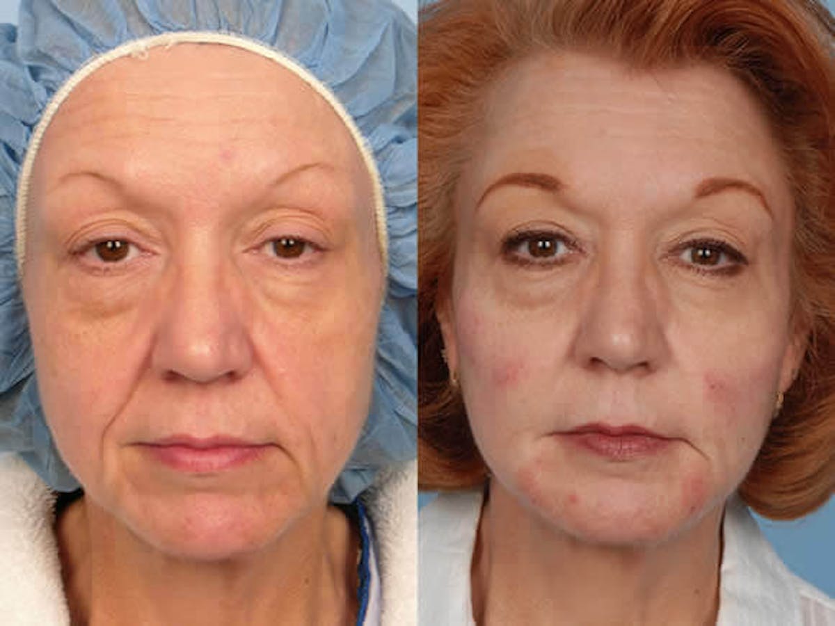 Lipotransfer Before & After Gallery - Patient 42063902 - Image 1