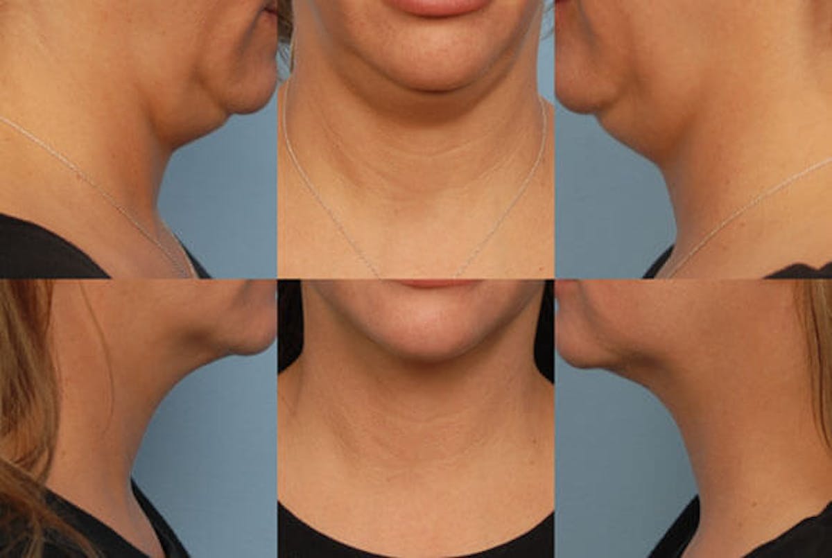 SmartLipo Before & After Gallery - Patient 42063906 - Image 1