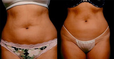 Non-Invasive Fat Reduction Before & After Gallery - Patient 42063909 - Image 1