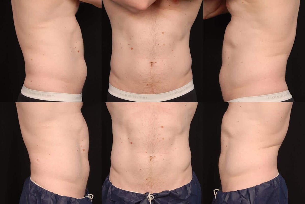 CoolSculpting Before & After Gallery - Patient 42063910 - Image 2