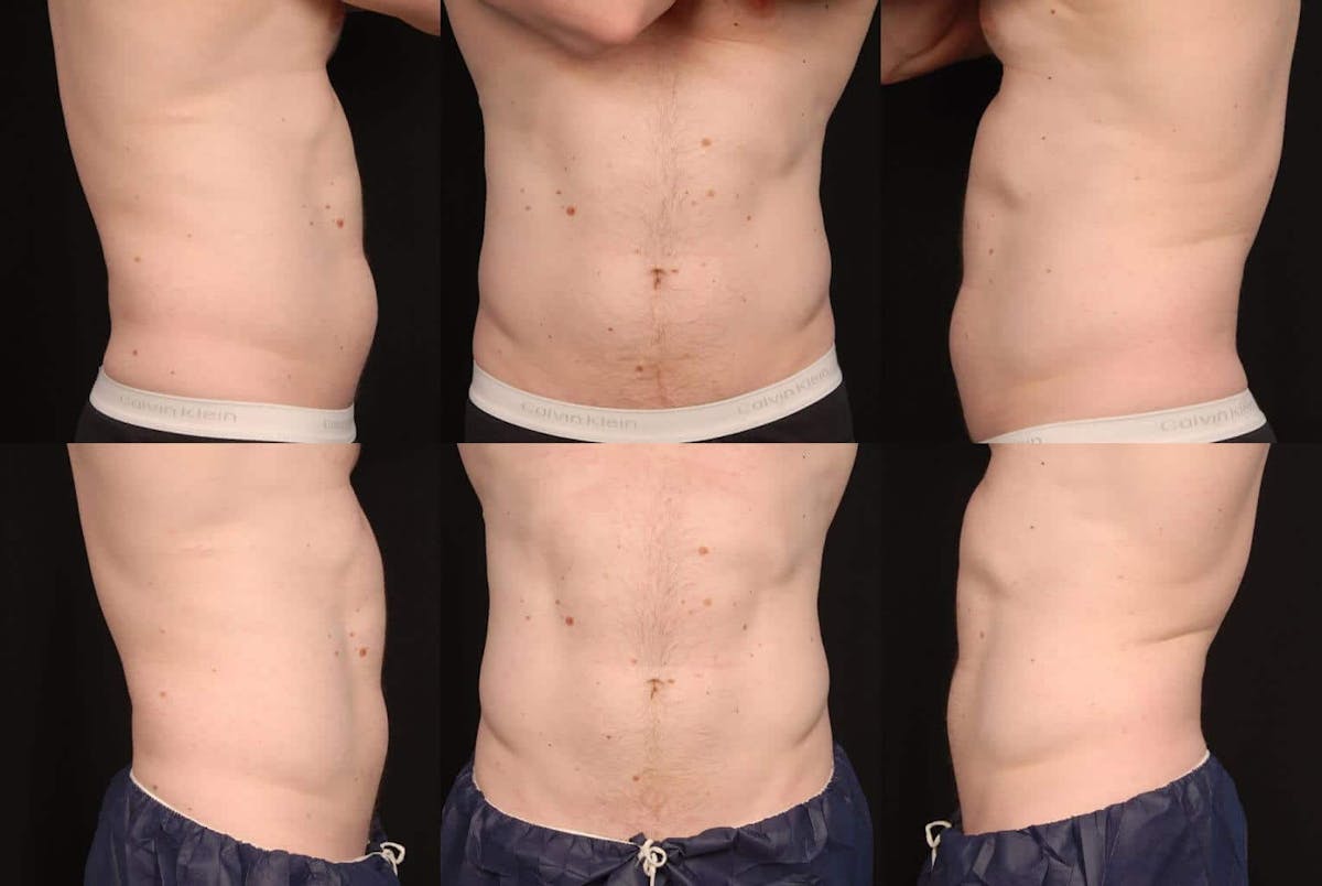 Non-Invasive Fat Reduction Before & After Gallery - Patient 42063910 - Image 2