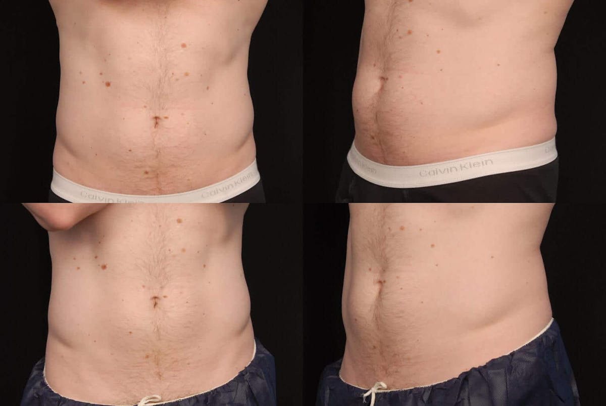CoolSculpting Before & After Gallery - Patient 42063910 - Image 1