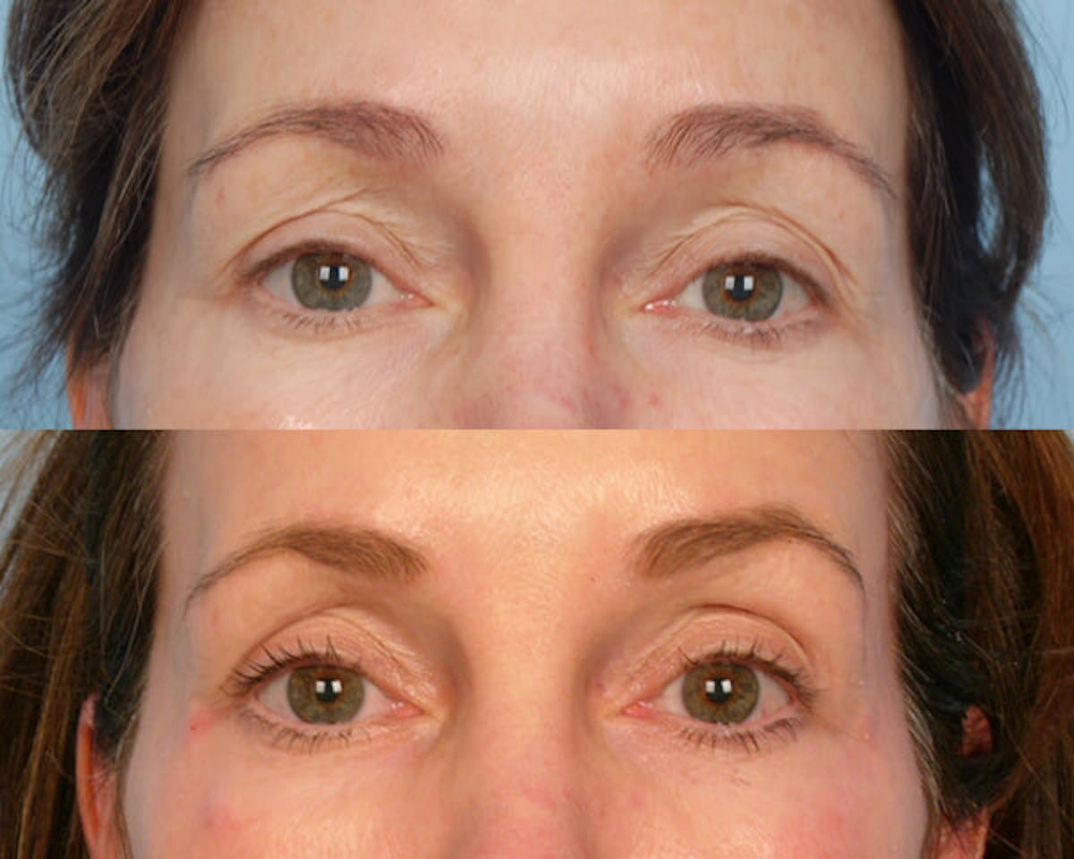 Thermage Before & After Gallery - Patient 42063917 - Image 1