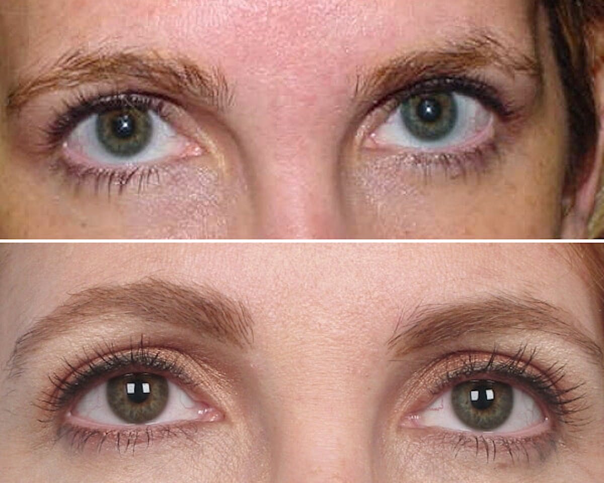 Thermage Before & After Gallery - Patient 42063918 - Image 1