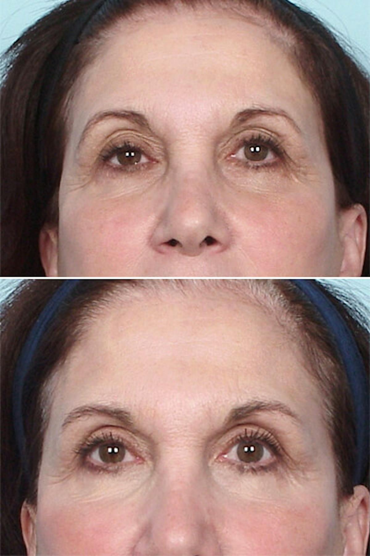 Thermage Before & After Gallery - Patient 42063920 - Image 1