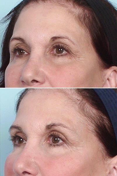 Thermage Before & After Gallery - Patient 42063920 - Image 2