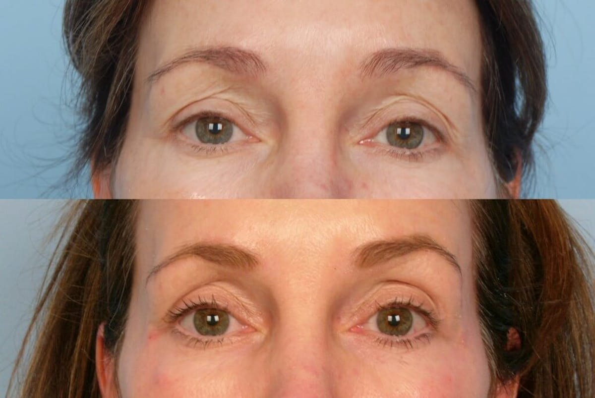 Thermage Before & After Gallery - Patient 42063922 - Image 1