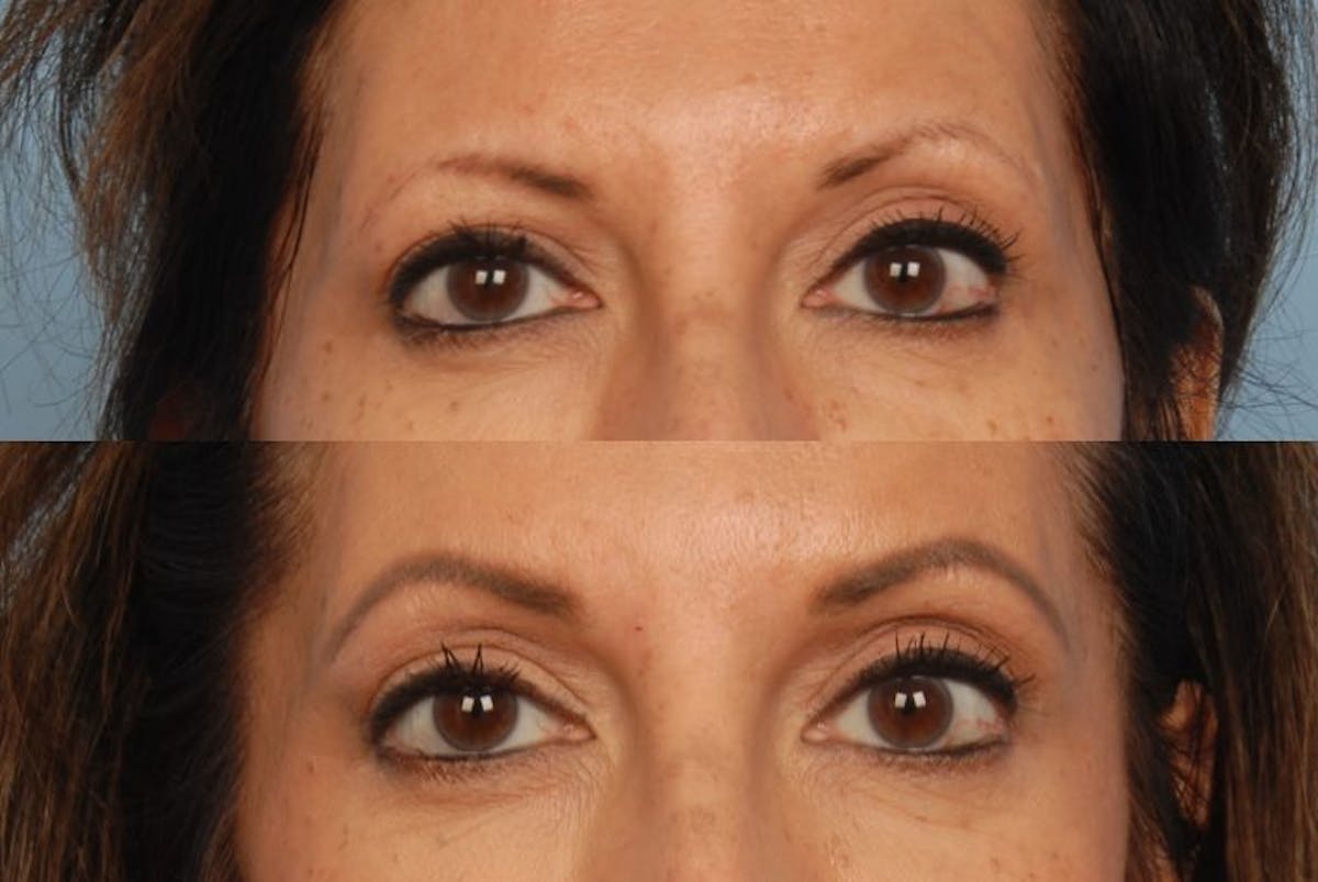 Thermage Before & After Gallery - Patient 42063923 - Image 1
