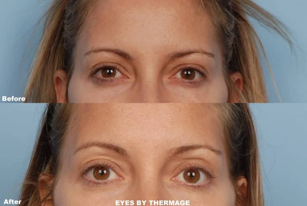 Thermage Before & After Gallery - Patient 42063924 - Image 1