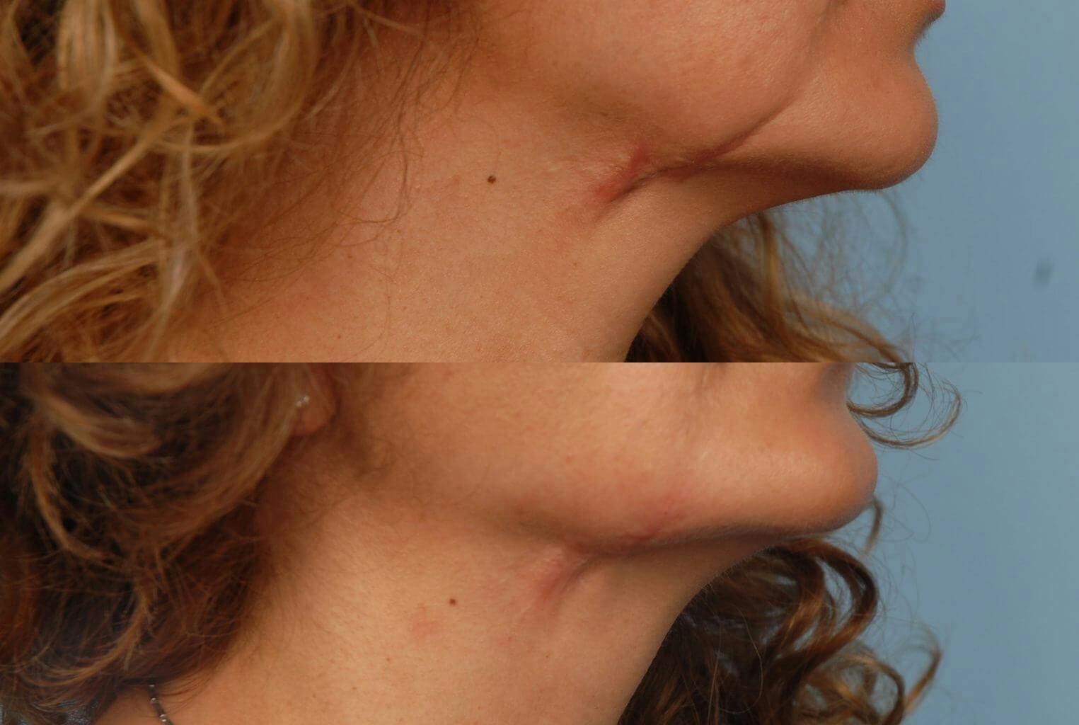 Scar Revision Before & After Gallery - Patient 42063925 - Image 1