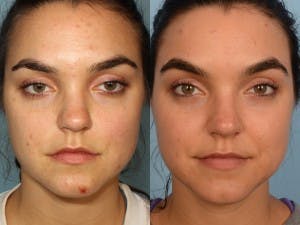 Acne Treatment Before & After Gallery - Patient 42065724 - Image 1