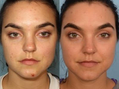 Acne Treatment / Aviclear Before & After Gallery - Patient 42065724 - Image 1