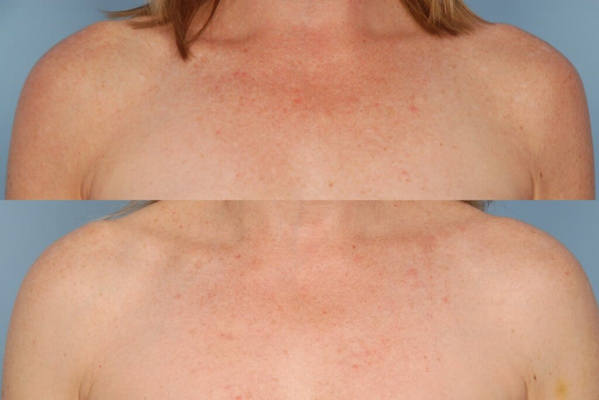 Photoderm Before & After Gallery - Patient 42065726 - Image 1