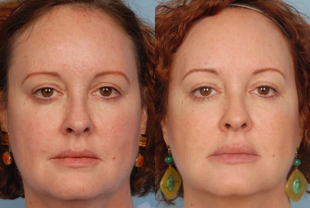 Photoderm Before & After Gallery - Patient 42065727 - Image 1