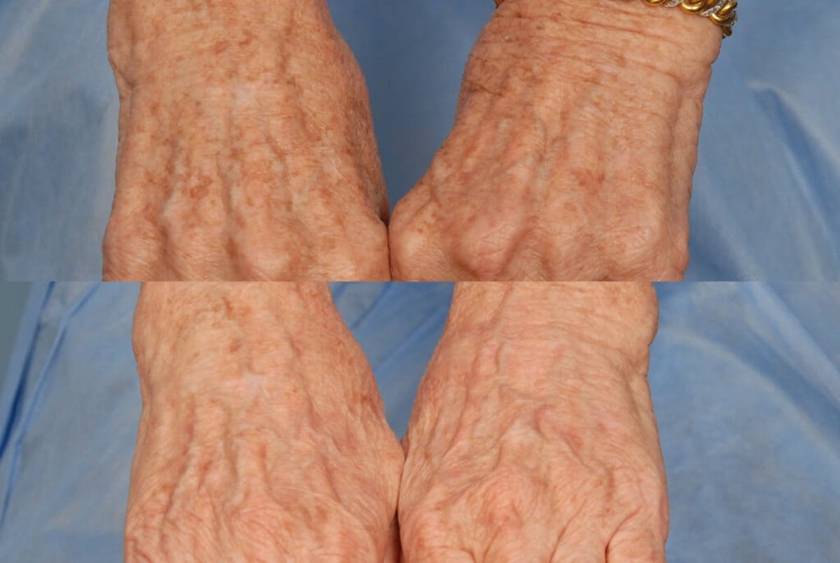 Crepey Skin Before & After Gallery - Patient 545748 - Image 1