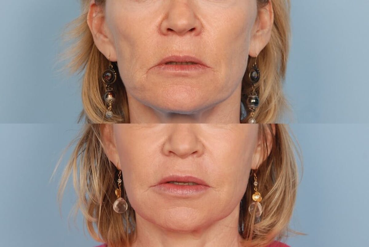 Lower Face Before & After Gallery - Patient 259427 - Image 1