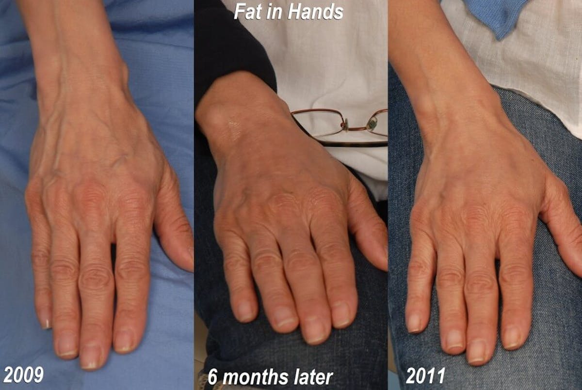 Crepey Skin Before & After Gallery - Patient 149849 - Image 1