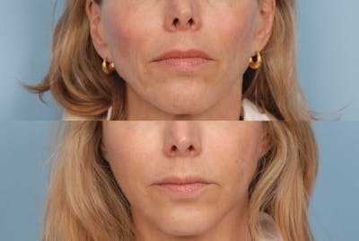 Lower Face Before & After Gallery - Patient 285910 - Image 1