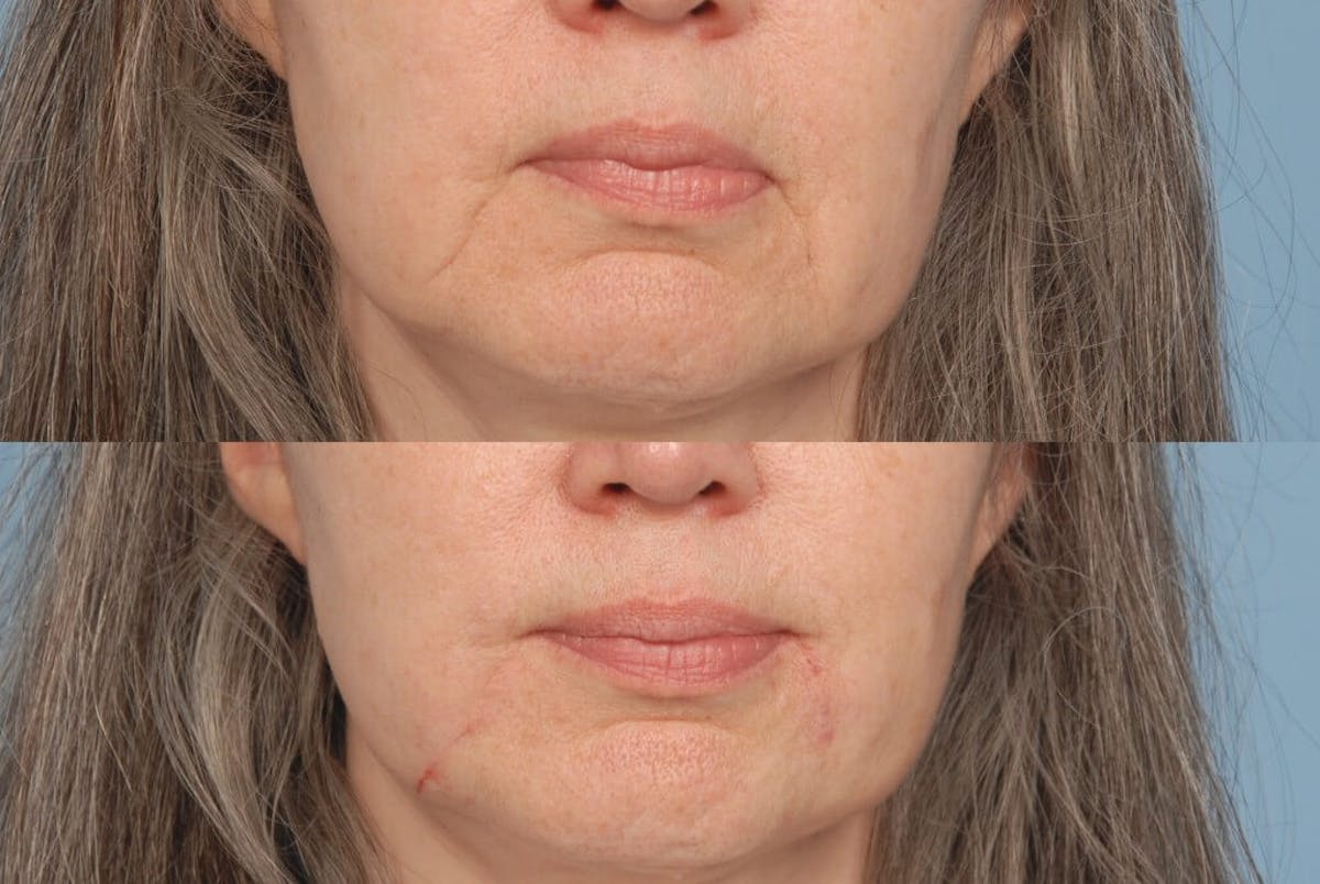 Lower Face Before & After Gallery - Patient 272233 - Image 1