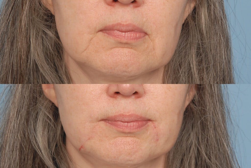 Fillers Before & After Gallery - Patient 173990095 - Image 1