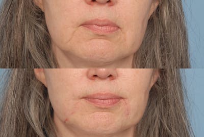 Lower Face Before & After Gallery - Patient 272233 - Image 1